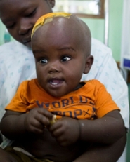 Net geopereerd patiëntje met waterhoofd in Uganda (bron: Cure Childrens Hospital of Uganda)